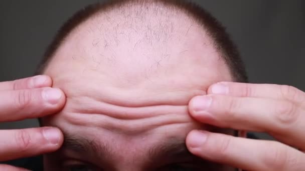 Arrugas Frente Hombre Primer Plano Expresión Facial Tratamiento Arrugas Concepto — Vídeos de Stock