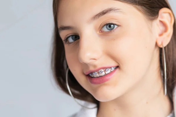 Happy Young Woman Face Girl Braces Teeth White Banner Background — Stock Photo, Image