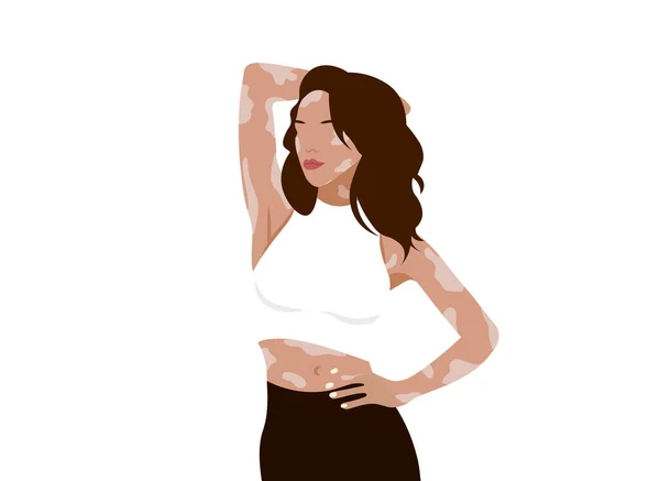 Estetik arka plan vitiligo depigmentasyon kadın, izole moda poster baskısı, güzellik sağlık hizmetleri kabul konsepti, çeşitlilik düz öz bakım portresi.