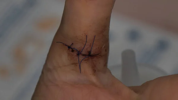 Puntadas en una herida de puñalada en el dedo pulgar de una mano de mujer caucásica Fotos De Stock