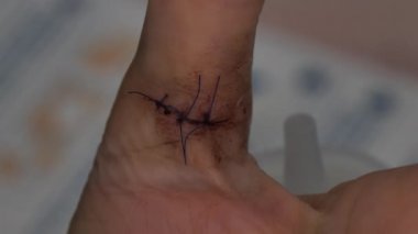 Kadın, dikişli yaralı bir baş parmak, dikişli derin bir kesik, yakın plan kesilmiş.