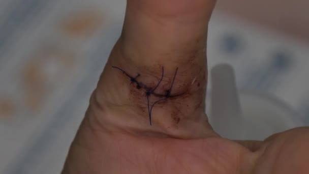 Mujer muestra su pulgar lesionado con puntos de sutura herida de corte dedo profundo cosido — Vídeos de Stock