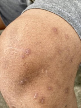 Deride yara enfeksiyonu. İnsan vücudunda bir yara, dikiş yaşlı, derin kesik, yara izi. Granülasyon dokuları ile kötü yara iyileşmesi