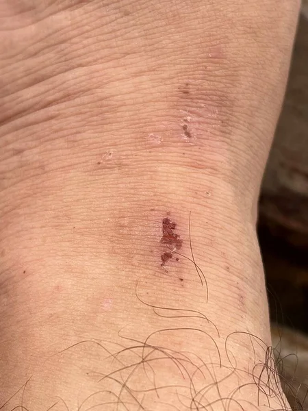 皮肤上的刀疤伤口是腿上的斑斑 右腿有长刺伤的人 — 图库照片
