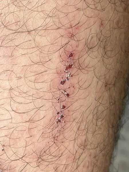 피부에 상처를 입힌다 상처는 다리에 딱지가나 오른쪽 다리에 상처를 — 스톡 사진