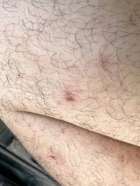 Cicatriz Piel Herida Forma Costras Pierna Hombre Con Larga Herida —  Fotos de Stock