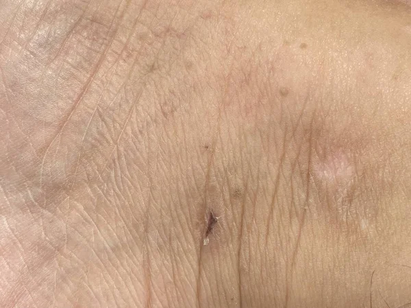 close up rash on skin
