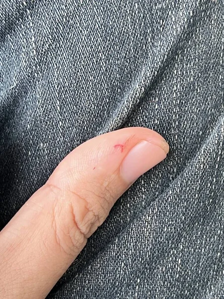 Ärr Vävnad Krossat Finger Som Har Läkt — Stockfoto