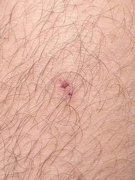 Vicino Cicatrice Sulla Pelle Umana — Foto Stock