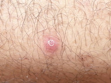 close up scar on human body