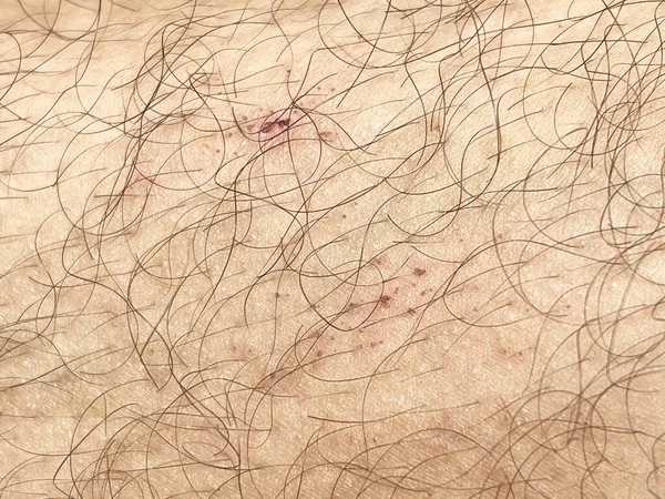 Close Scar Human Body — Fotografia de Stock