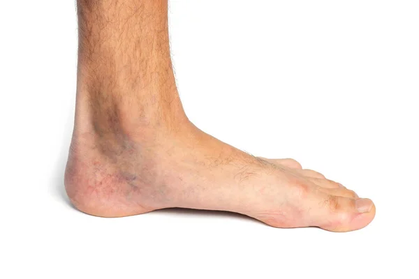 Foot Man Leg Varicose Veins Isolated White Background — Photo