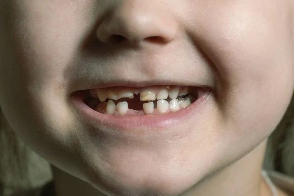 Children\'s mouth with fallen and broken milk teeth.