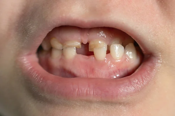 Children\'s mouth with fallen and broken milk teeth.