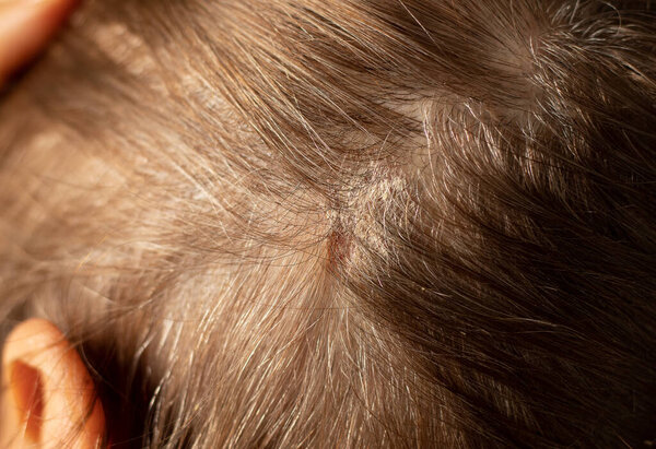 Сухая зудящая скальп с струпьями на голове женщины с волосами. Перхоть себорея на коже. Крупный план.