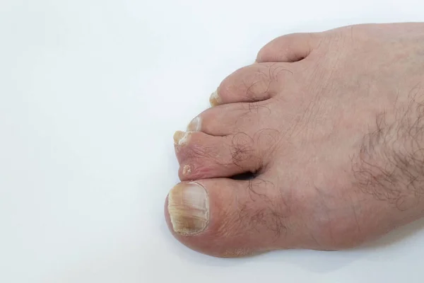 Centrální Polydaktylie Palci Lidské Nohy Izolované Bílém Pozadí Vzácná Anomálie — Stock fotografie