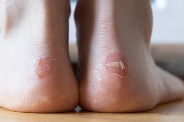 Blister on a barefoot female heel. A close-up. Painful dry callus on a woman\'s feet skin. Dermatology problem, uncomfortable skin condition.