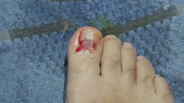Domestic Accident Wound Cut Blood Male Foot Possible Fracture Big — Video