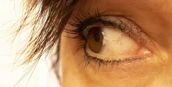 地中海ラテン語の女性の素敵な茶色の栗の目 Pingueculaと呼ばれる眼の結節性間質変性を示します ストックフォト