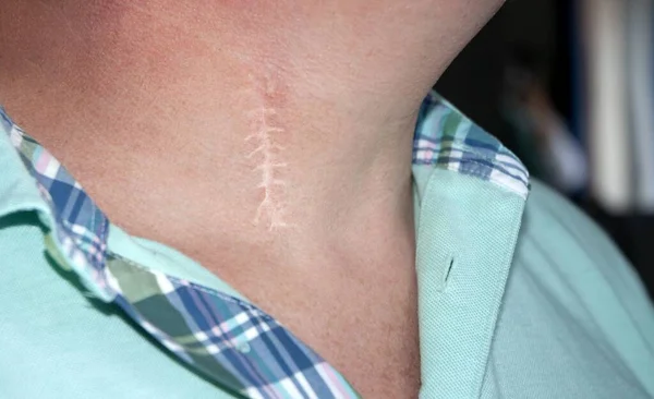 頸部ディスクのヘルニアの外科的介入の後 首に残っている傷 — ストック写真