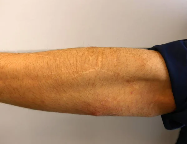 白人男性の腕の上に強迫性障害自己負担傷 — ストック写真