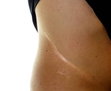 Böbrek naklinden dolayı sağ tarafta cerrahi yara izi var.