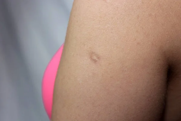 Scar Smallpox Vaccination Visible Mature Woman Upper Arm — ストック写真