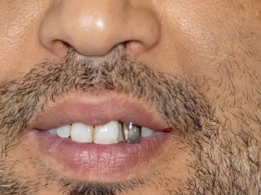 Diş hijyeni ve diş hekimliği, birkaç gün sakallı biri altın ya da gümüş diş implantı gösteriyor.