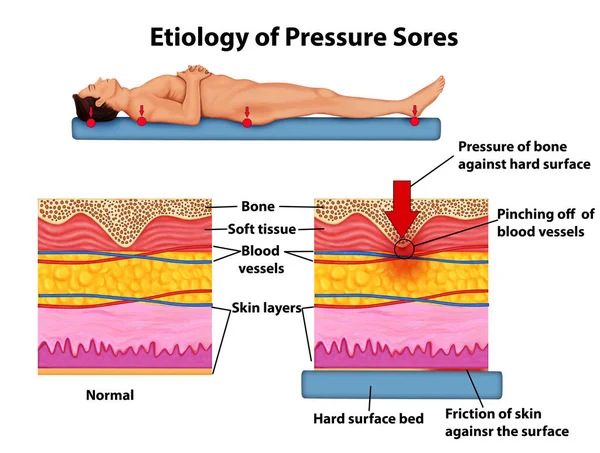 Etiologia Ilustração Anatomia Das Úlceras Pressão — Fotografia de Stock