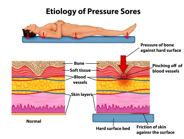 Etiología Las Úlceras Por Presión Anatomía Ilustración — Foto de Stock