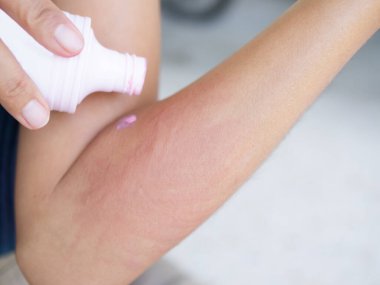 Eldeki ürtiker, hava zehirlenmesinden dolayı ölümcül olmayan bir kadın. Koluna Calamine losyonu sürüyor. Hasta, alerjik reaksiyon gösteriyor. Vücutta ürtikya. Sağlık hizmeti kavramı..