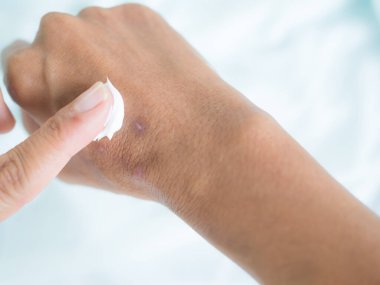 Scar on hand woman. finger applying removal blister wound on skin body with blue background. drug medicine cosmetic cream lotion moisturizer for beauty and good health. showing dark scar skin tan.
