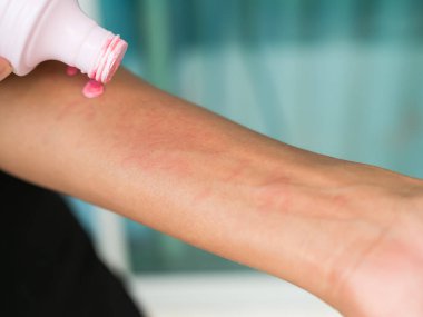 Eldeki ürtiker, hava zehirlenmesinden dolayı ölümcül olmayan bir kadın. Koluna Calamine losyonu sürüyor. Hasta, alerjik reaksiyon gösteriyor. Vücutta ürtikya. Sağlık hizmeti kavramı..
