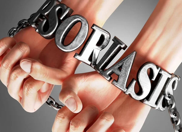 Psoriasis, social impact and its influence - a concept showing a person\'s hands in chains with a word Psoriasis as a symbol of its burden and misery it bring to human life, 3d illustration