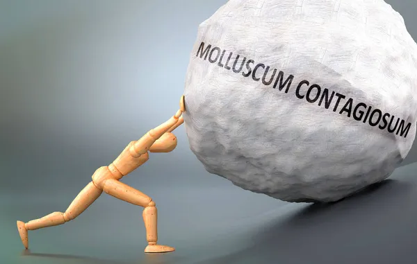 Darstellung Von Molluscum Contagiosum Mit Einem Hölzernen Modell Das Schweres — Stockfoto