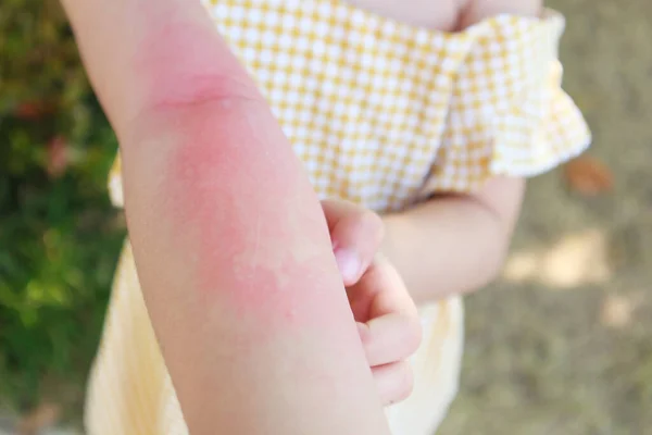 Klein Meisje Heeft Huiduitslag Allergie Jeuk Aan Haar Arm — Stockfoto