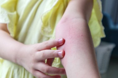 Küçük kızın cildinde isilik alerjisi ve kolunda kaşıntı var.