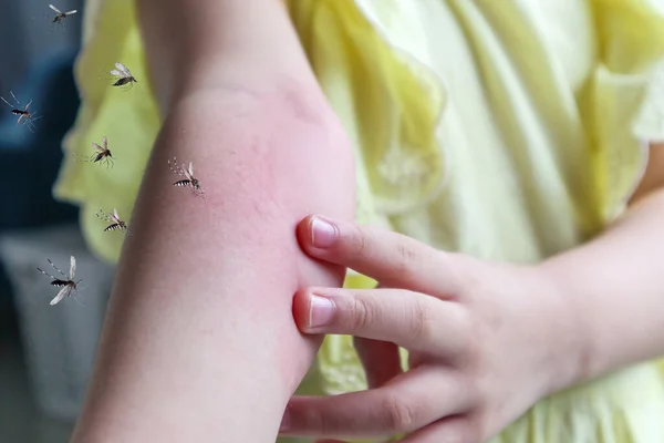Κοριτσάκι Έχει Δερματικό Εξάνθημα Αλλεργία Και Φαγούρα Στο Χέρι Της — Φωτογραφία Αρχείου