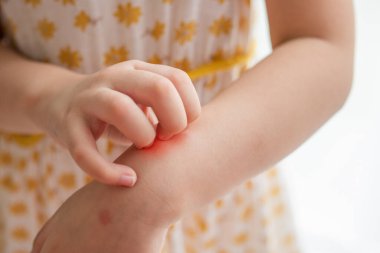 Little girl has skin rash allergy itching and scratching on her arm