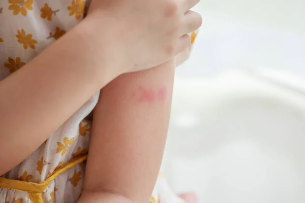 Маленькой Девочки Аллергия Сыпь Кожу Зуд Царапины Руке — стоковое фото