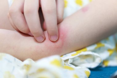 Little girl has skin rash allergy itching and scratching on her arm