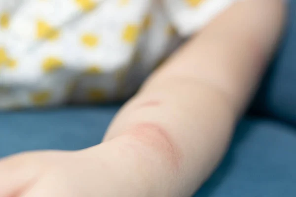 Little Girl Has Skin Rash Allergy Itching Scratching Her Arm — Stockfoto