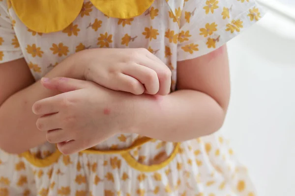 Little Girl Has Skin Rash Allergy Itching Scratching Her Arm — Stockfoto