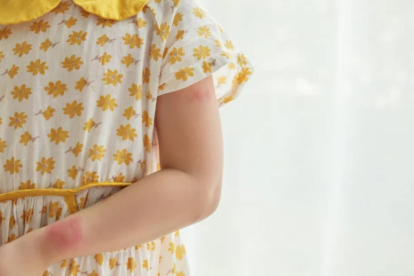 Little Girl Has Skin Rash Allergy Itching Scratching Her Arm — Stockfoto