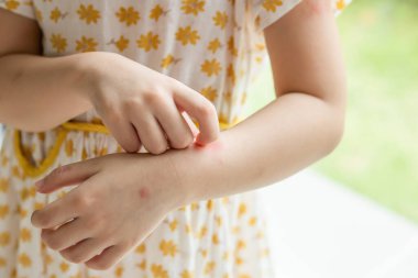 Little girl has skin rash allergy itching and scratching on her arm