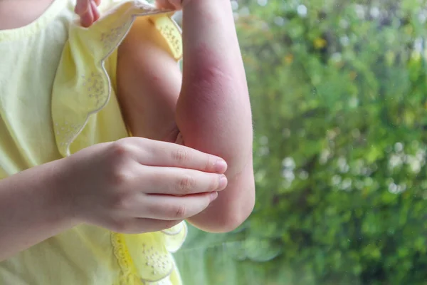 Klein Meisje Heeft Huiduitslag Allergie Jeuk Aan Haar Arm — Stockfoto