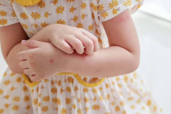 Little Girl Has Skin Rash Allergy Itching Scratching Her Arm — Zdjęcie stockowe