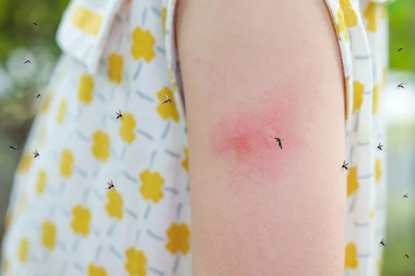 Little Girl Has Skin Rash Allergy Itching Scratching Her Arm — Stock Photo, Image