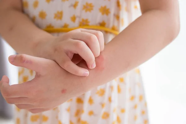 Little Girl Has Skin Rash Allergy Itching Scratching Her Arm — Stock Photo, Image