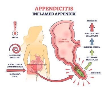 Apandisit, iltihaplı apandis, abdominal sorun teşhis şeması.